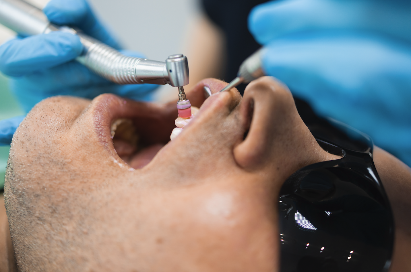 detartrasi guida pulizia professionale denti