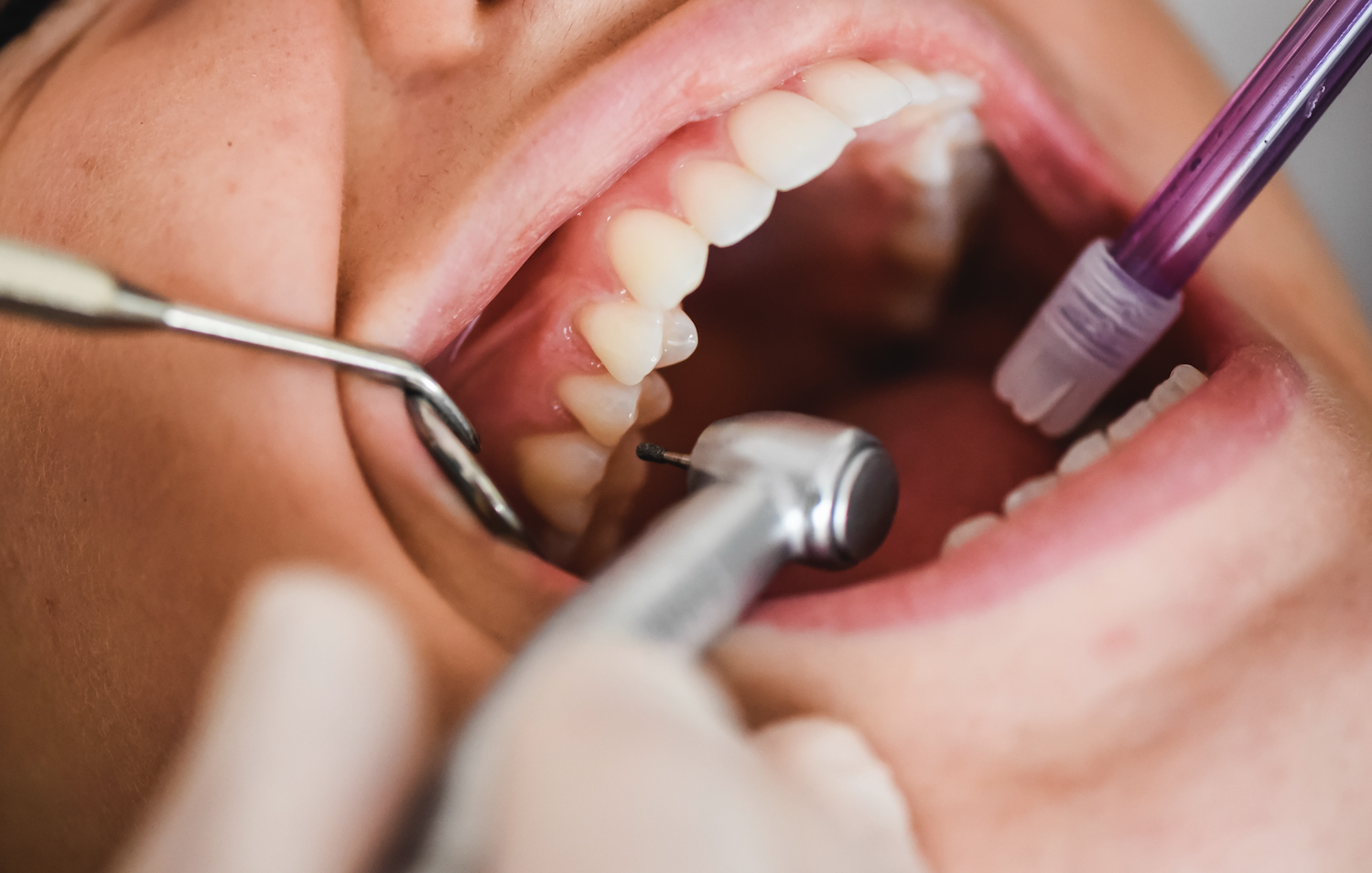 pulizia denti a ultrasuoni cose perche efficace